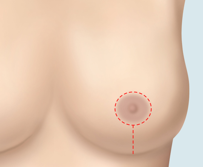 수직 절개 축소술