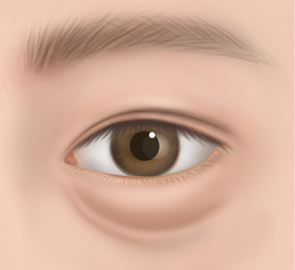 디자인 후 절개