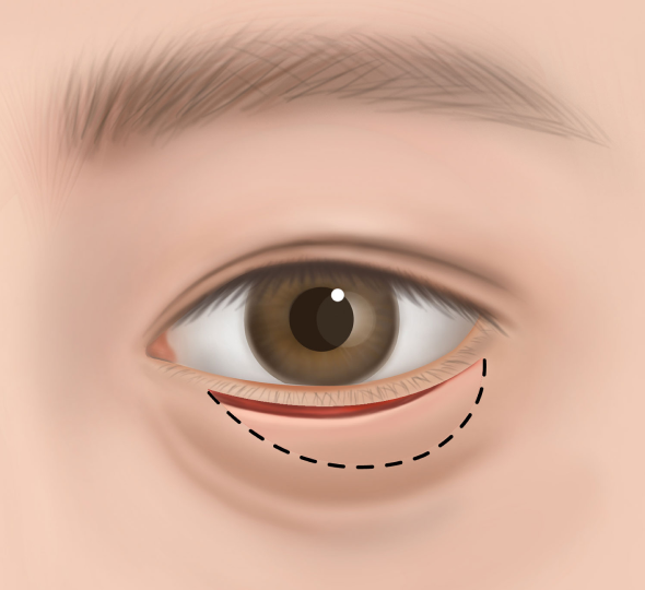 박리 후 지방 재배치